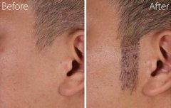 鬓角种植整形术的优势有哪些