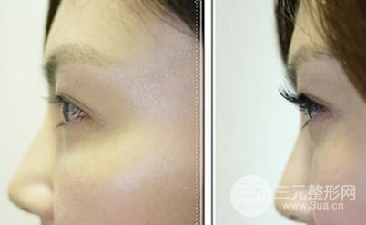 种睫毛要多少钱好不好？睫毛种植后睫毛会掉吗?