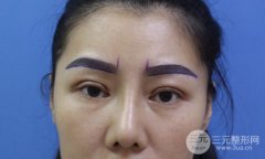 眉毛种植效果对比 种植眉毛案例手术前后