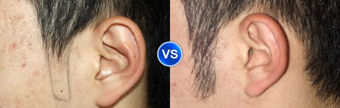 北京京都疤痕医院专家跟大家聊一聊翼角手术的效果到底怎么样 ？