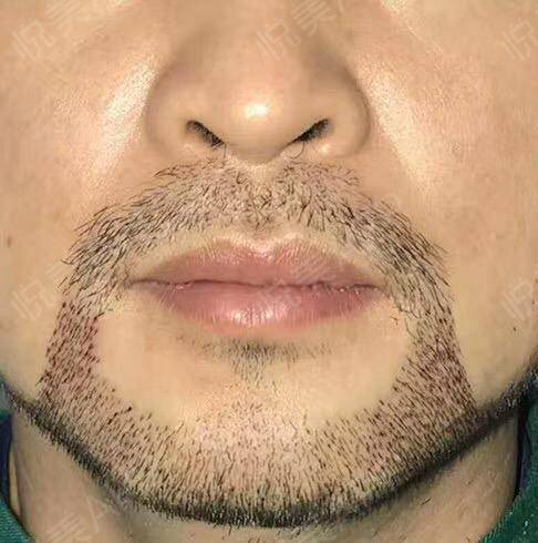 胡须种植手术时间长吗，恢复期是多久？