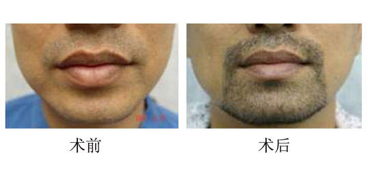 胡须种植手术安全吗，过程是否可靠