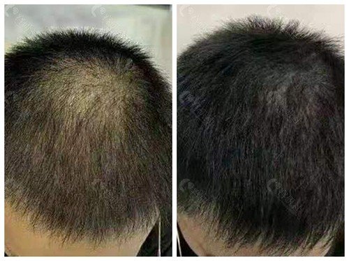 种植头发需要多少钱？头发少的有救了​