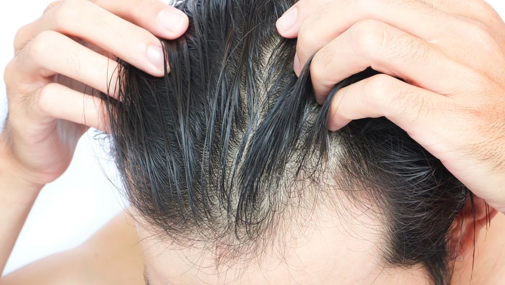 种植头发需要多少钱？有多少个疗程呢？