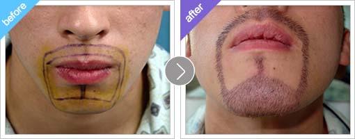 胡须种植手术后，胡须可存活多长时间？