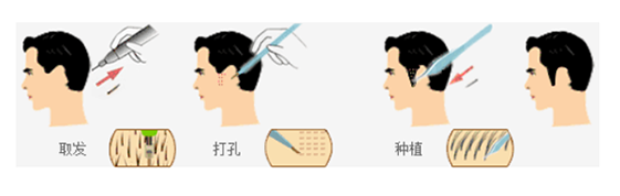 ​头发种植手术可以有效改善掉发脱发，大概的价格是多少？