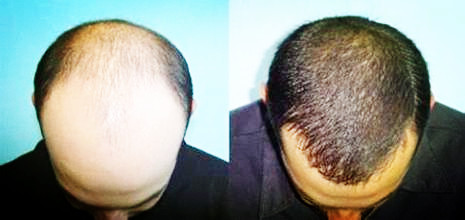 头发种植发没有掉落后，头发恢复正常生长吗？