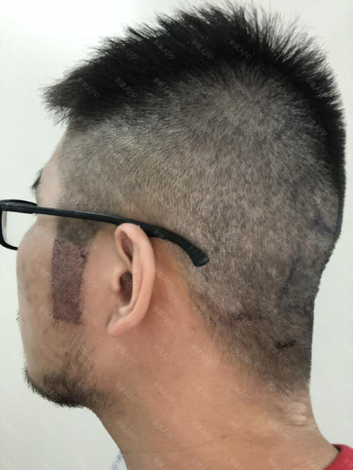 鬓角种植的步骤和优势有哪些？​