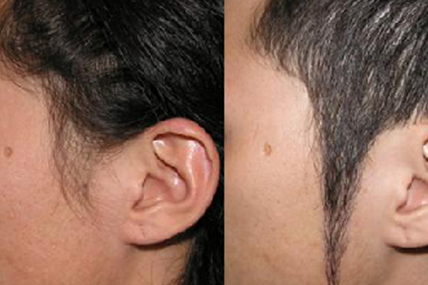 植发后要做些什么护理以促进术后的恢复效果优良